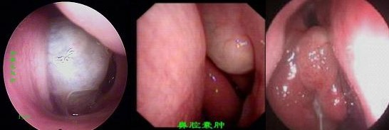 2、鼻腔肿瘤引起失嗅，如鼻息肉、鼻腔乳头状瘤等。治疗方法是手术切